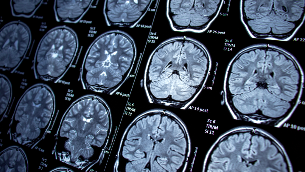 Le projet CANDLE recrute un ou une doctorante pour travailler sur la modélisation computationnelle neuro-inspirée des médicaments antiépileptiques. La thèse sera accueillie au LTSI – Laboratoire Traitement du Signal et de l’Image, à l’Université de Rennes.